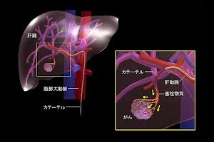 カテーテルによる塞栓術