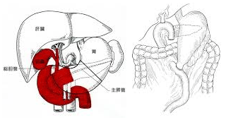 幽門輪温存膵頭十二指腸切除術（Pylorus-preserving Pancreatoduodenectomy）