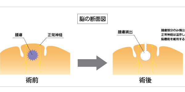 脳の断面図