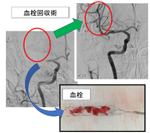 カテーテルによる血栓回収