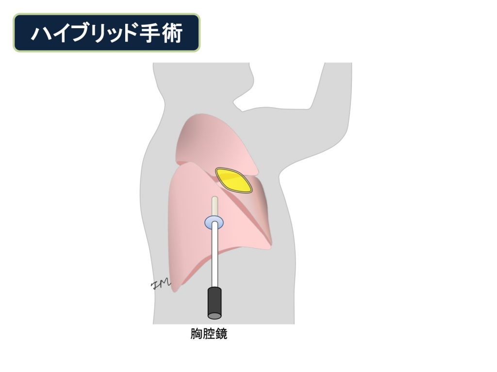 胸腔 鏡 下 肺 切除 術