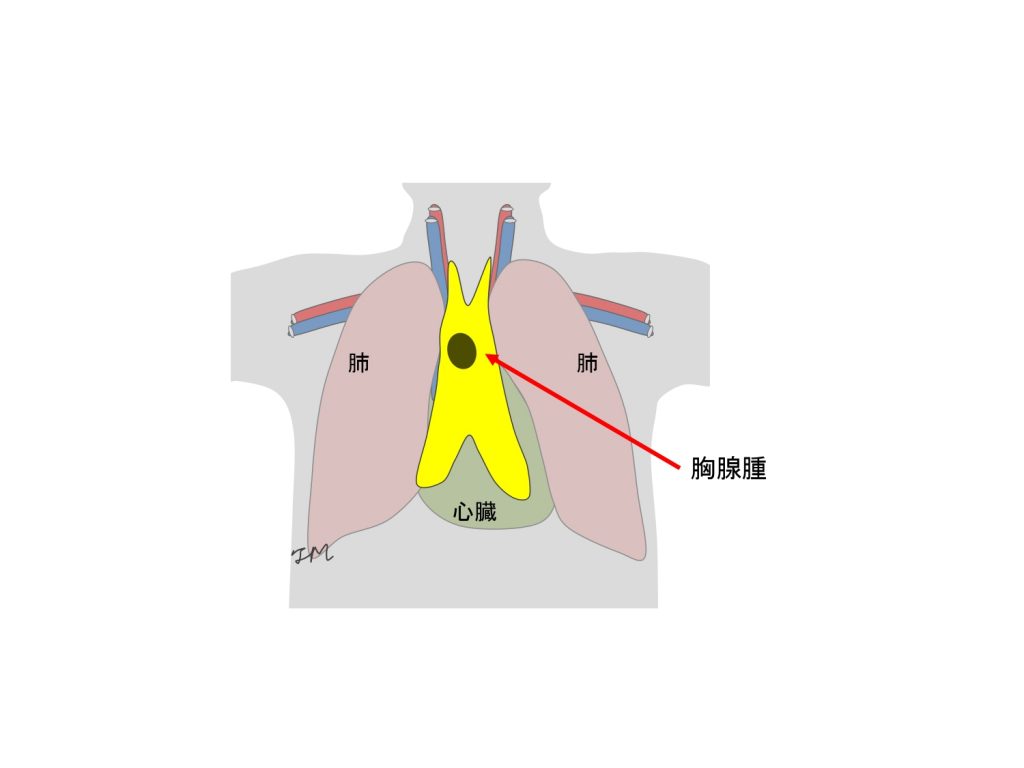 胸腺腫 胸腺摘出手術 |呼吸器外科|診療科・部門紹介|香川県立中央病院