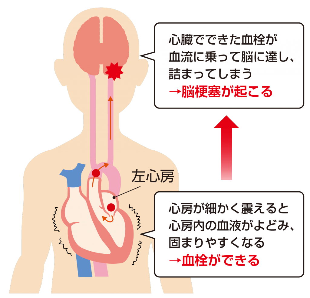 問題1　脳梗塞になる理由