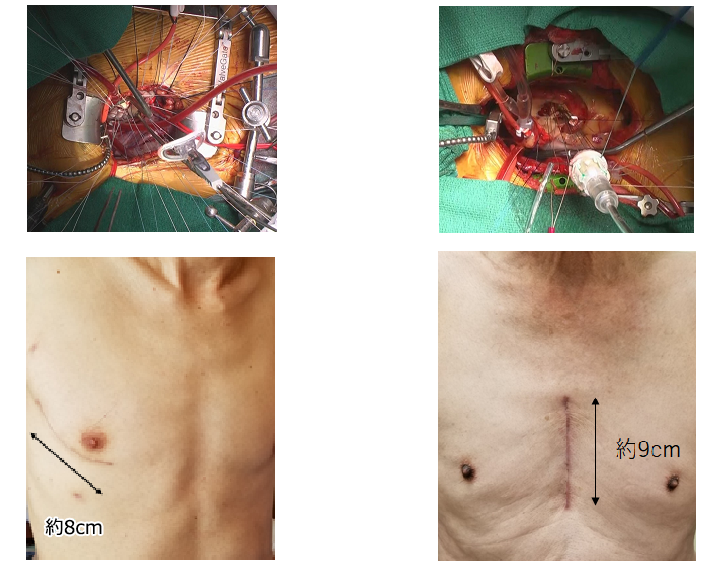 小切開心臓手術 写真
