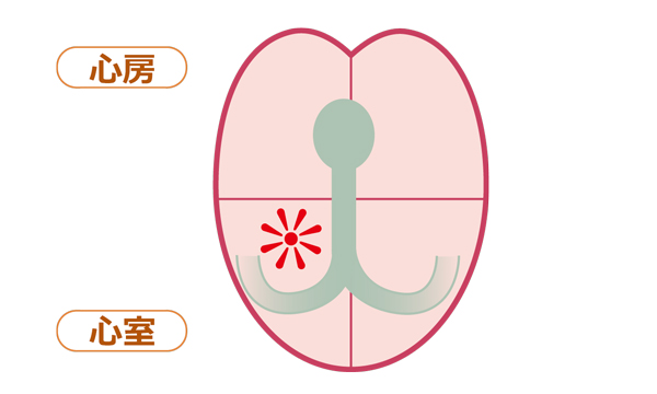 特発性心室頻拍