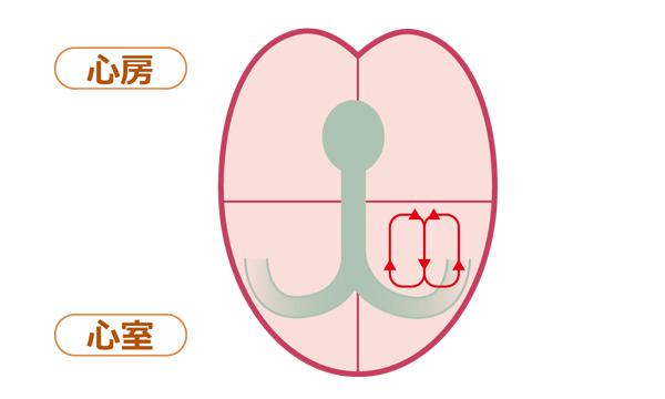 二次性心室頻拍