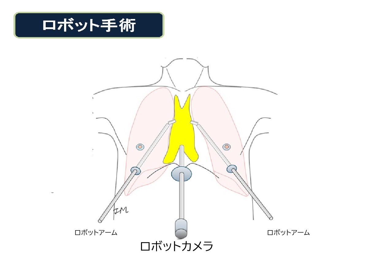 ロボット手術