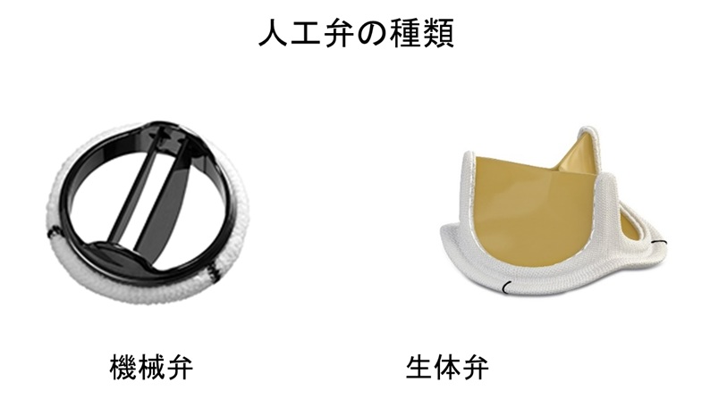 人工弁の種類