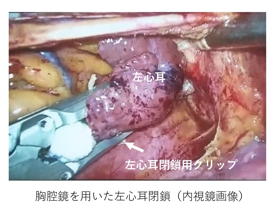 胸腔鏡を用いた左心耳閉鎖（内視鏡画像）